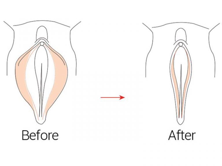 عمل لابیاپلاستی و تاثیر آن در زیبایی واژن