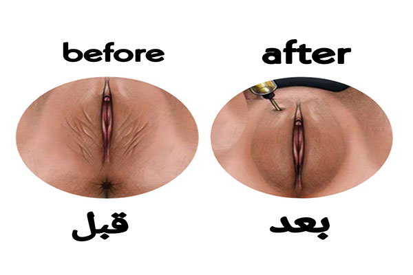مراقبت های بعد از تزریق ژل به بیکینی+هزینه تزریق ژل به بیکینی+تنگ کننده بیکینی
